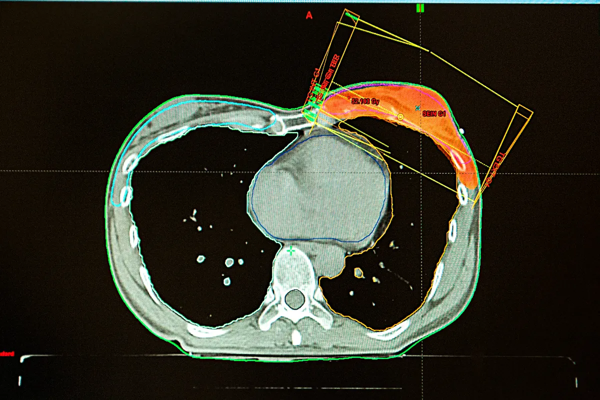 Radiographie - Oncocare